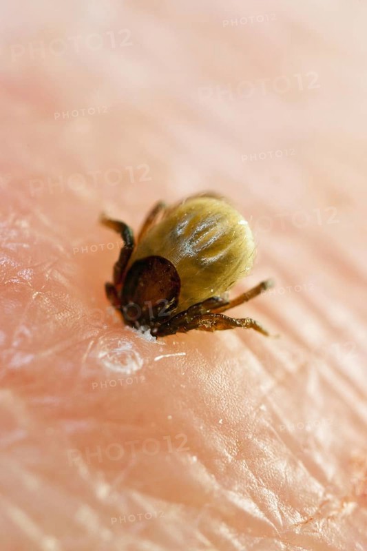 Tick bitten into human skin, common Castor Bean Tick (Ixodes ricinus), tick bite