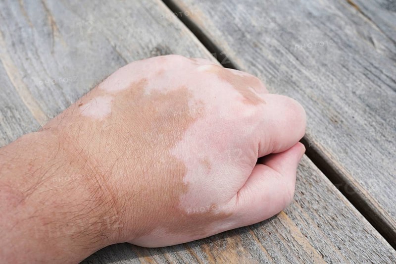 male hand with vitiligo skin condition, characterized by white unpigmented patches or blotches