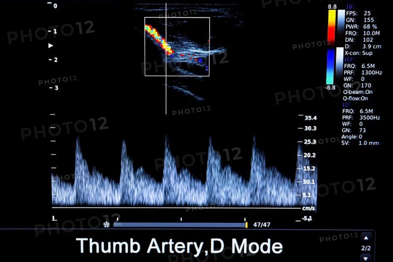 Colourful image of modern ultrasound monitor. Ultrasonography machine. High technology medical and healthcare equipment. Ultrasound imaging or sonography used in medicine. Thumb artery
