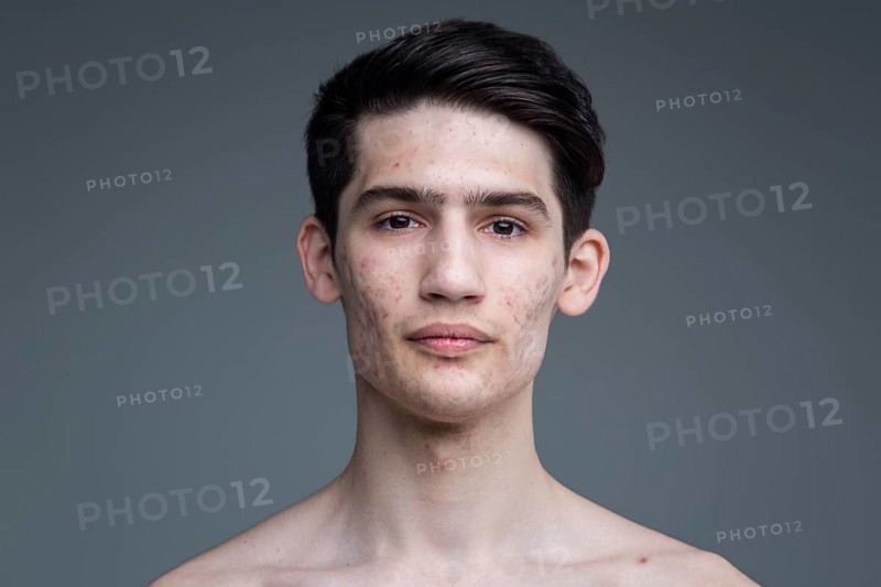 Studio portrait of a young brunette caucasian man on grey background posing. Puberty theme, problem skin, teen acne