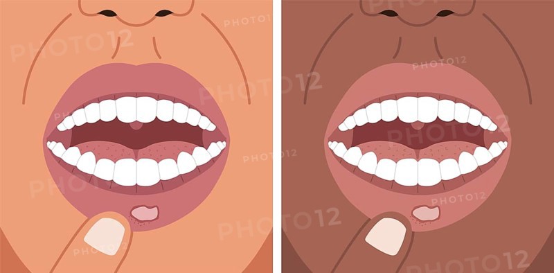 Vector illustration canker sore, aphthous ulcer on the lip, stomatitis