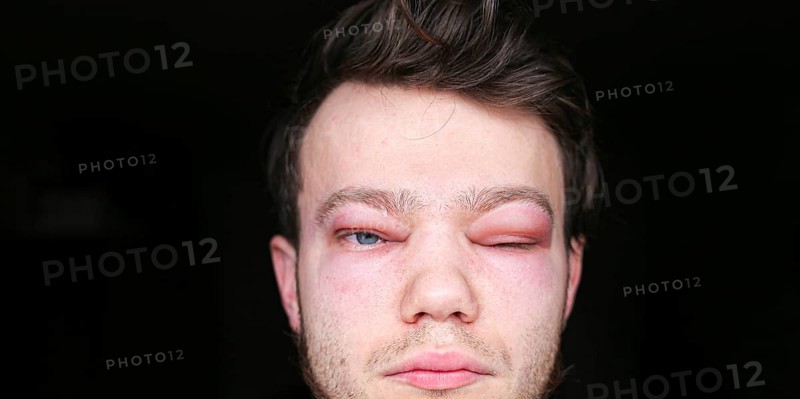 A person with a swollen eye partially closed in moderate lighting allergic reaction on the lip angioedema in a man, consequences of hyaluronic acid injections