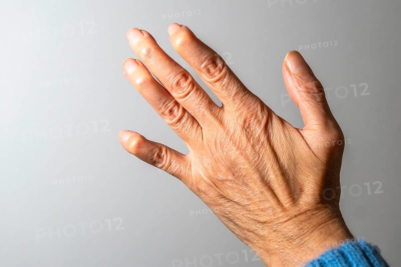 Close up view of a hand exhibiting swollen finger joints, emphasizing the painful effects of arthritis on mobility and daily life