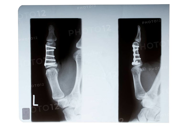 Thumb bone nailed in X-ray image