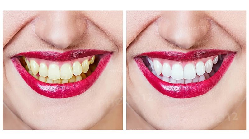 Whitening - bleaching treatment, before and after, woman teeth and smile isolated on white