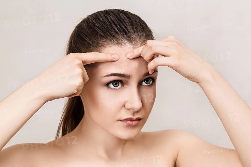 Young girl squeezes pimple on her forehead over beige background