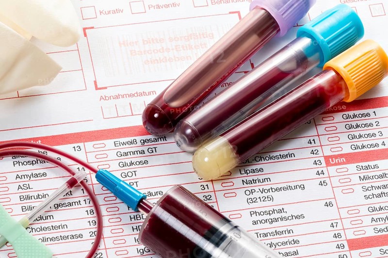 Blood samples are taken on a laboratory form to determine the blood values