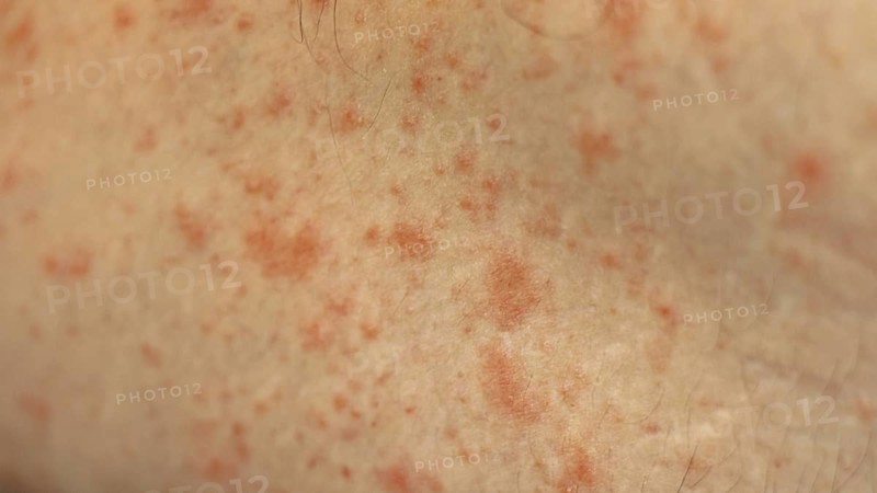 Close up to patches of inflammation called milk rash or atopic dermatitis on an adult caucasian skin caused by an allergic reaction to cow's milk