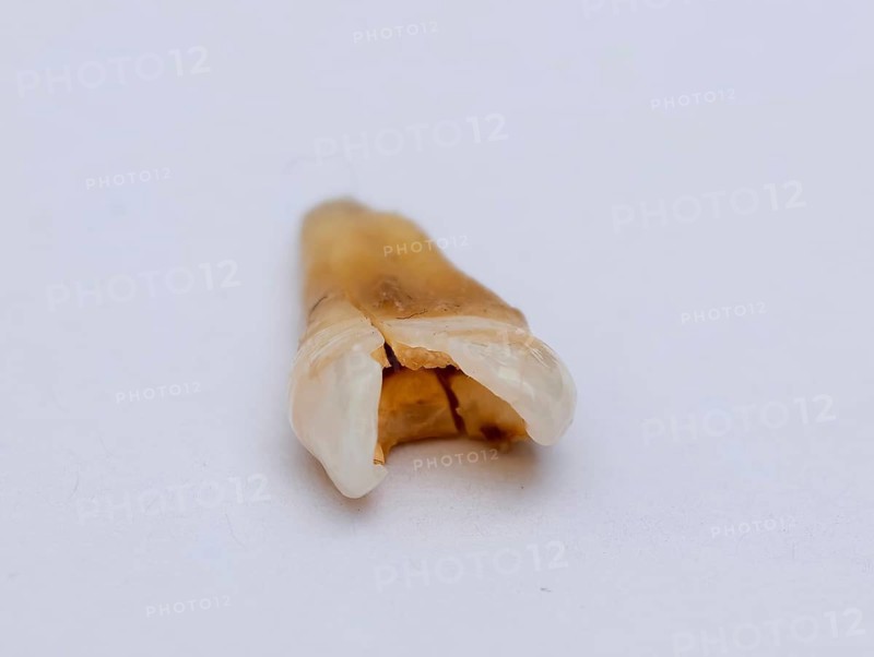 Pulled out, cracked and damaged, tooth, second premolar on a white background, Karaganda, Kazakhstan