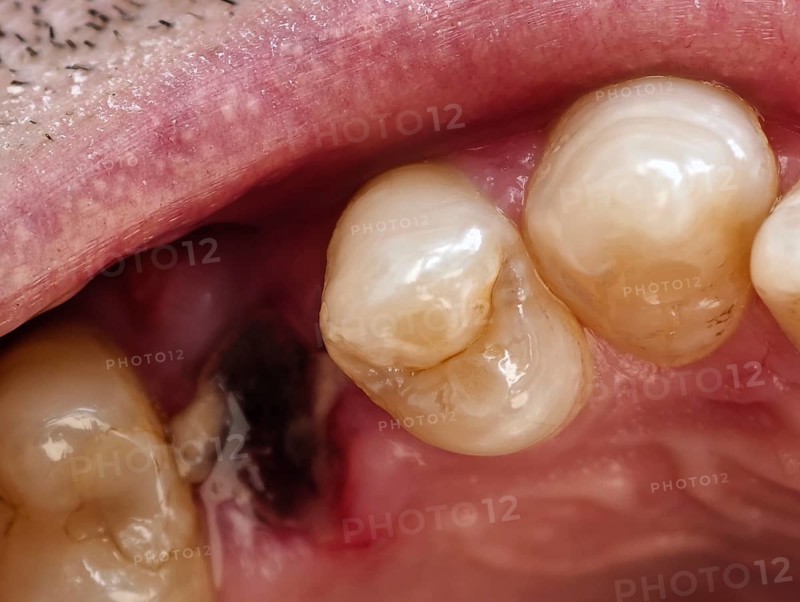 Open mouth of a man with the place of a pulled out small molar tooth, healing of a wound in the place of the tooth. Karaganda, Kazakhstan