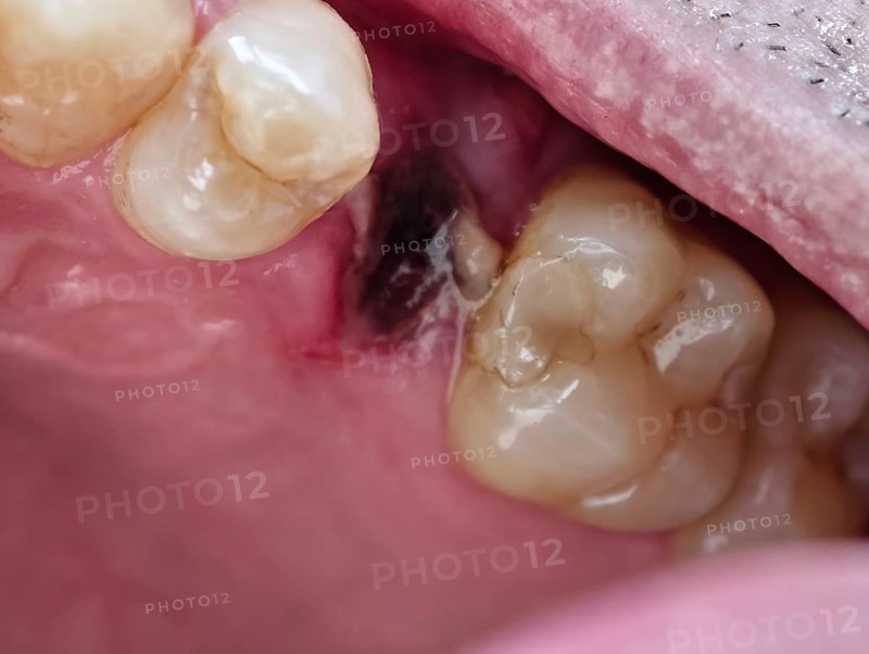 Open mouth of a man with the place of a pulled out small molar tooth, healing of a wound in the place of the tooth, Karaganda, Kazakhstan