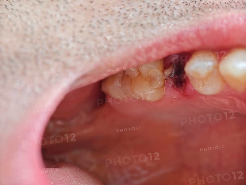 Open mouth of a man with the place of a pulled out small molar tooth, healing of a wound in the place of the tooth. Karaganda, Kazakhstan