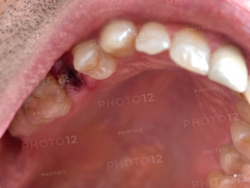 Open mouth of a man with the place of a pulled out small molar tooth, healing of a wound in the place of the tooth, Karaganda, Kazakhstan