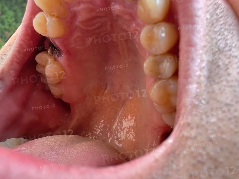 Open mouth of a man with the place of a pulled out small molar tooth, healing of a wound in the place of the tooth. Karaganda, Kazakhstan