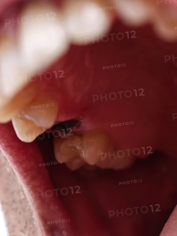 Open mouth of a man with the place of a pulled out small molar tooth, healing of a wound in the place of the tooth. Karaganda, Kazakhstan