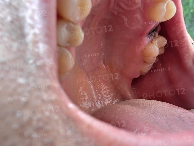 Open mouth of a man with the place of a pulled out small molar tooth, healing of a wound in the place of the tooth. Karaganda, Kazakhstan