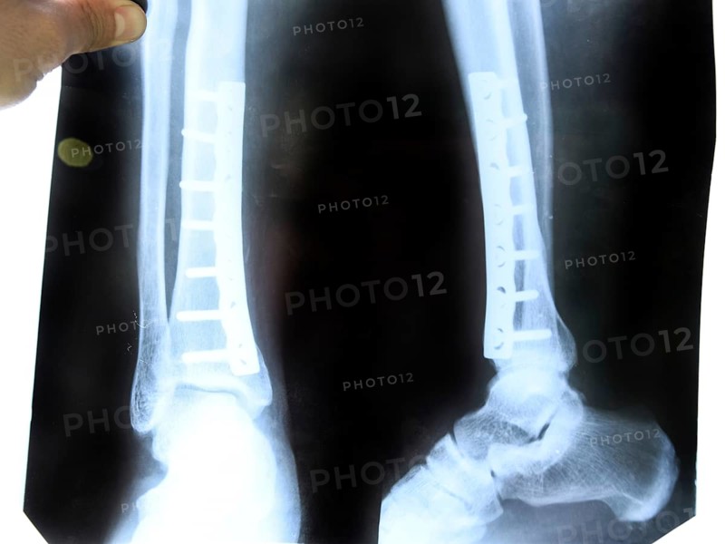 X-ray of the leg. Atyrau, Kazakhstan