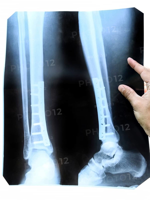 X-ray of the leg. A steel plate holding together the tibia of the leg. Krasnodar, Russia