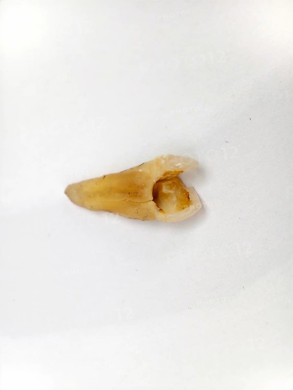 Pulled out, cracked, and damaged tooth, second premolar on a white background, Karaganda, Kazakhstan