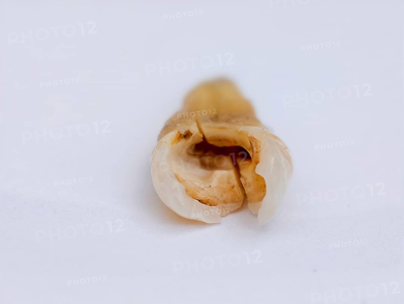 Pulled out, cracked, and damaged tooth, second premolar on a white background, Karaganda, Kazakhstan