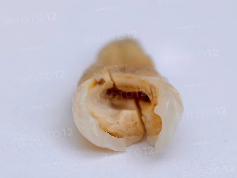 Pulled out, cracked, and damaged tooth, second premolar on a white background, Karaganda, Kazakhstan
