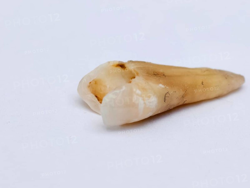 Pulled out, cracked and damaged, tooth, second premolar on a white background. Karaganda, Kazakhstan