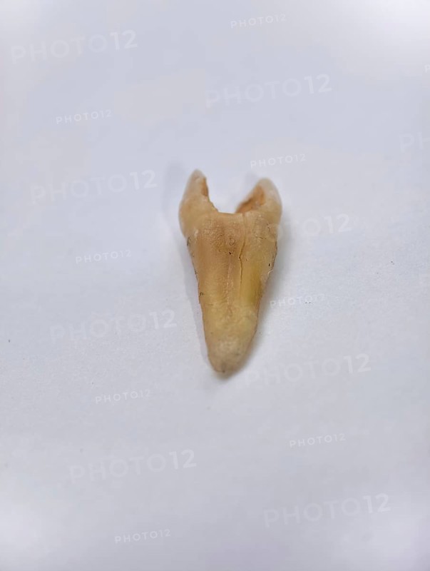Pulled out, cracked and damaged tooth, second premolar on a white background, Karaganda, Kazakhstan