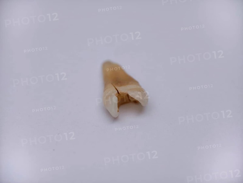 Pulled out, cracked and damaged tooth, second premolar on a white background. Karaganda, Kazakhstan