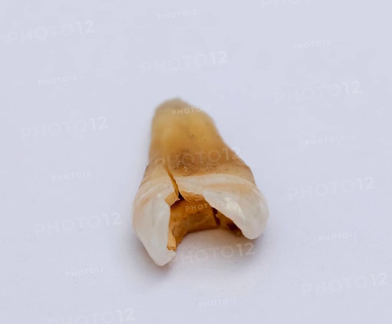 Pulled out cracked and damaged tooth, second premolar on a white background. Karaganda, Kazakhstan