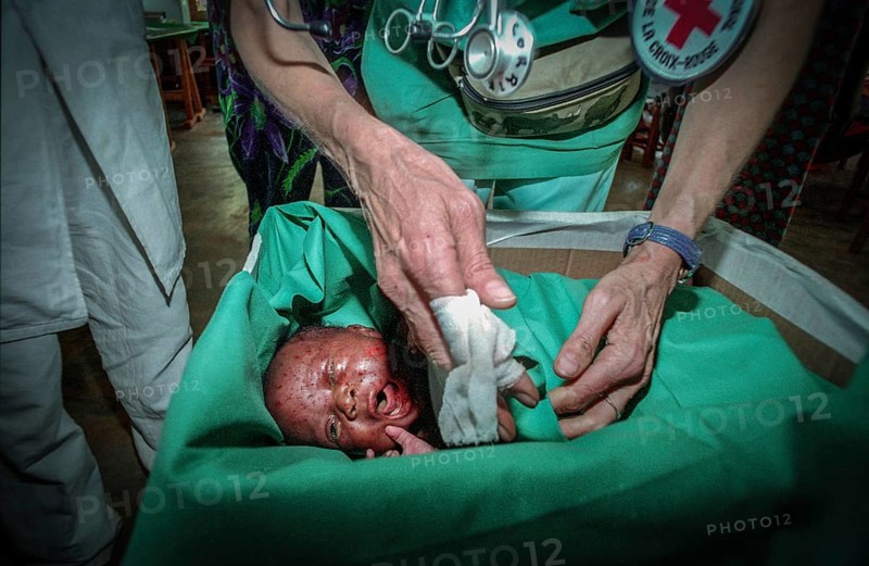 RWA Rwanda Kigali An injured Tutsi refugee child is receiving medical care in a makeshift hospital by doctors from Doctors Without Borders, MSF. It survived the genocide, which claimed the lives of 800, 000 people within 100 days. RWA Rwanda Kigali An injured Tutsi refugee baby in a temporary hospital run by Doctors without Borders