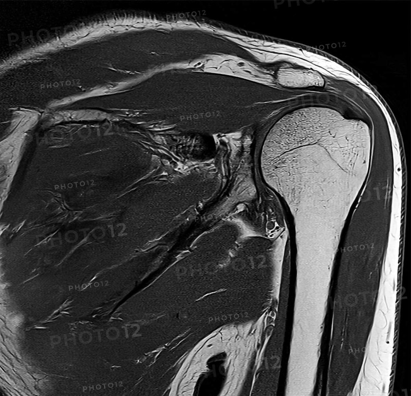 Black and white MRI of a human shoulder joint with visible bones and soft tissues