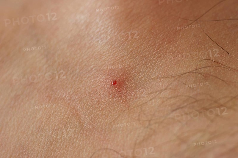 Black fly bite, skin, people, São Paulo, Brazil