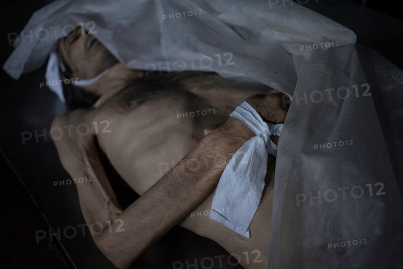 Body of a man who died of tuberculosis, morgue of the State Hospital, Chisinau, Moldova