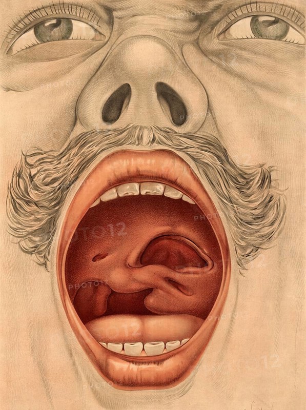 Medical illustration, clinical picture, venereal disease, palate perforation caused by syphilis, perforation, late stage tertiary syphilis, from destructive inflammation, school picture, authentic reproduction of a school mural, around 1900, exact date unknown, historical