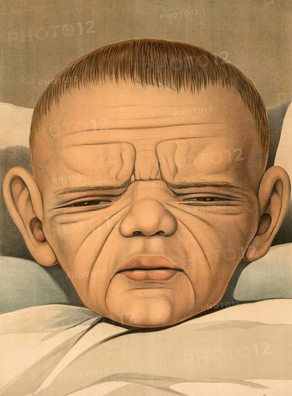 Medical illustration, clinical picture, venereal disease, syphilis, hereditary syphilis, child with senile face, congenital syphilis, a sexually transmitted disease caused by the bacterium Treponema pallidum, school picture, authentic reproduction of a school mural, around 1900, exact date unknown, historical