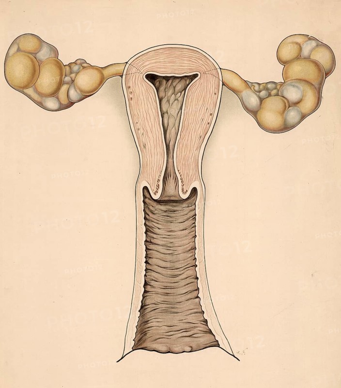 Medical illustration, clinical picture, venereal disease, gonorrhea, female reproductive organs altered by gonorrhea, cervicitis, uterus, endometritis, fallopian tubes, salpingitis and ovaries, oophoritis, school picture, authentic reproduction of a school mural, around 1900, exact date unknown, historical