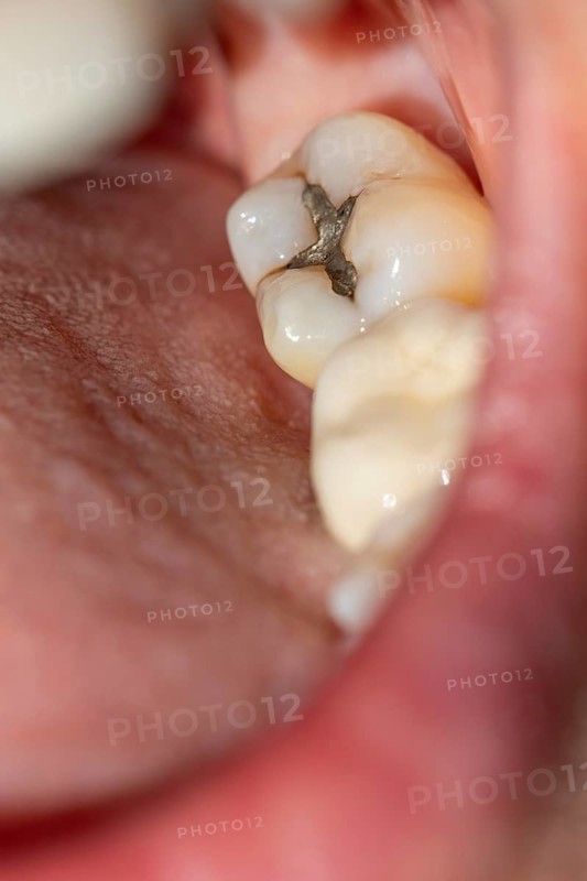 Woman with her mouth open shows a visible amalgam filling on her molar during a dental examination in a dental practice in Germany