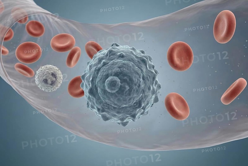 Microscopic visualisation of a rare circulating tumour cell (CTC) in the bloodstream, which stands out clearly from the surrounding erythrocytes and leukocytes due to its irregular shape. Oncology, immunology, immunotherapy, AI generated