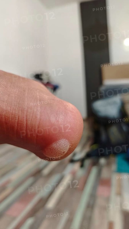 Hiking, tight shoes, close-up of a painful, large blister on the heel with skin detail in focus, blurred background