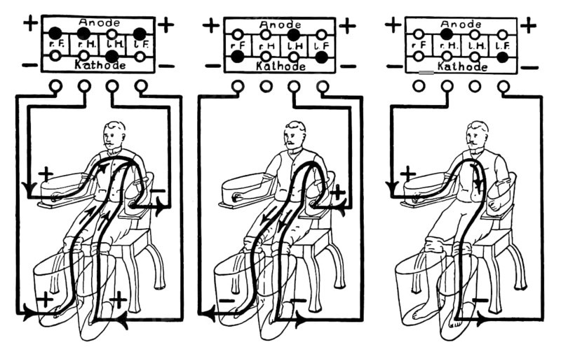An illustration of a patient being treated with a four cell Schnee Bath, an early electric medical equipment for treating rheumatism