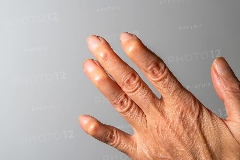 Close up of a female hand demonstrating the visible effects of rheumatoid arthritis, highlighting swollen joints and skin changes