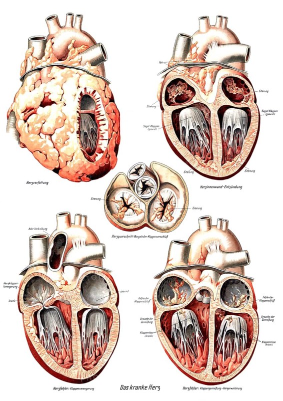 Anatomy, human, various pathological changes of the human heart, fatty heart, heart inner wall inflammation, heart cross section and valve defects, valve constriction, valve rupture and heart enlargement, reproduction of a historical school picture, mural or teaching board, authentic, exact date unknown