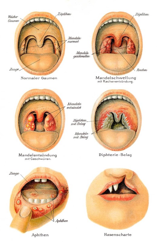 Mouth and throat diseases, health counselor, 19th century, Mund- und Rachenkrankheiten, Gesundheitsratgeber, 19. Jahrhundert