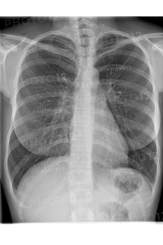 X-ray photograph of front view of woman's chest with diagnosis pulmonary emphysema with flattening of the diaphragm, widened intercostal spaces and drop shaped heart