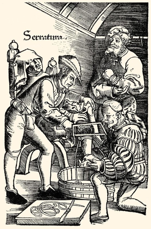 German surgeon, amputation of leg without anaesthetic, Hans van Gersdorff, 1528, 'Feldtbuch der Wundartzney' (Field book of surgery), Deutscher Chirurg, Amputation des Beines ohne Betäubung, Hans van Gersdorff, 1528 Feldtbuch der Wundartzney