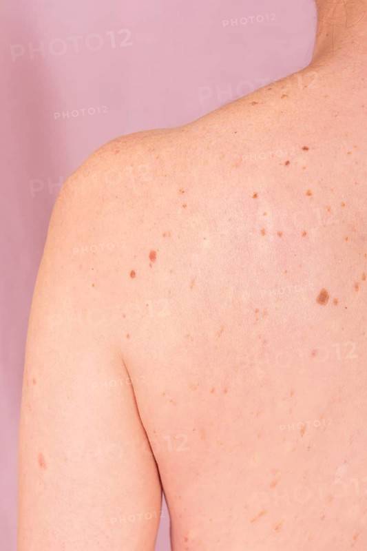 Close-up image of a person's back highlighting moles and pigmentation. Represents the importance of regular skin checks in skin cancer awareness