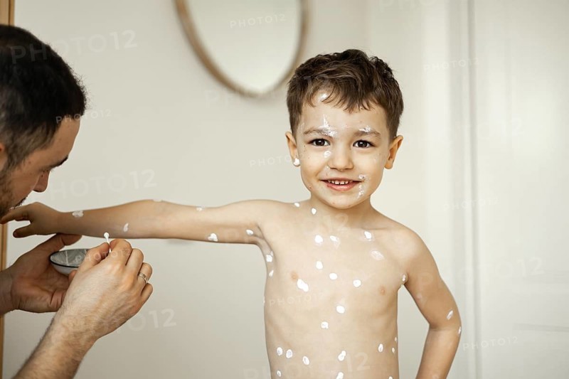 A caring father gently applies soothing cream to his young son's chickenpox rash, providing comfort and relief in a nurturing parent-child moment at home