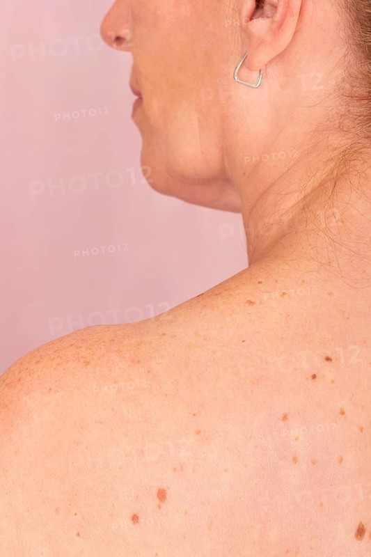 Close-up of a woman's skin with moles, promoting awareness against skin cancer. Highlights health, prevention, and the importance of regular check-ups