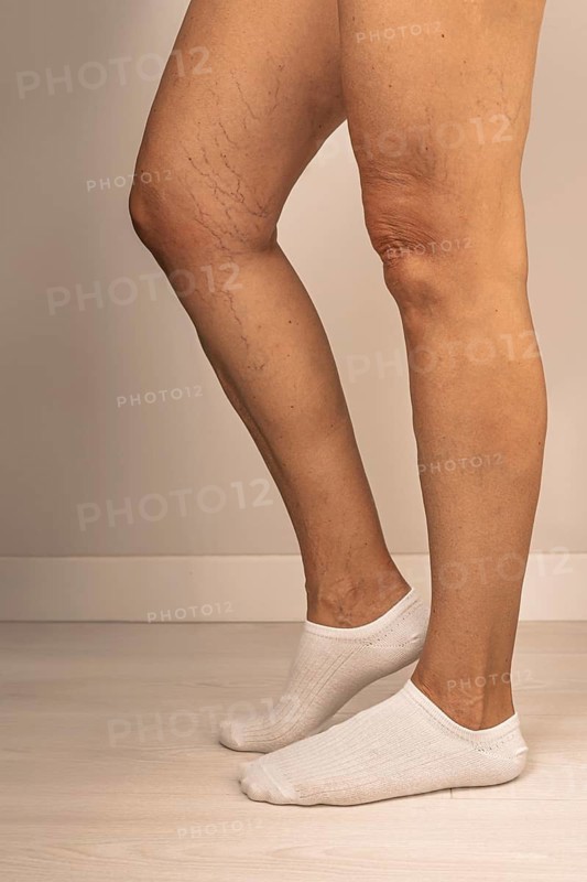 Close-up of a person's legs showing varicose veins and visible capillaries. The individual is wearing white ankle socks. The skin tone is light with noticeable vascular patterns
