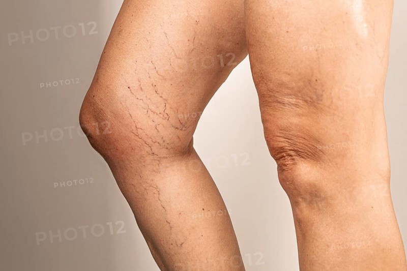 Close-up of a human leg showing varicose veins and visible capillaries. The skin appears slightly wrinkled and uneven, highlighting vascular issues